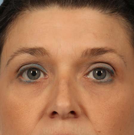 Ultherapy®, case 1, before