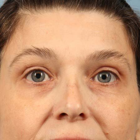 Ultherapy®, case 1, after
