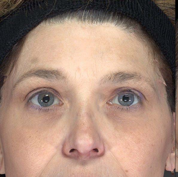 Ultherapy®, case 2, before