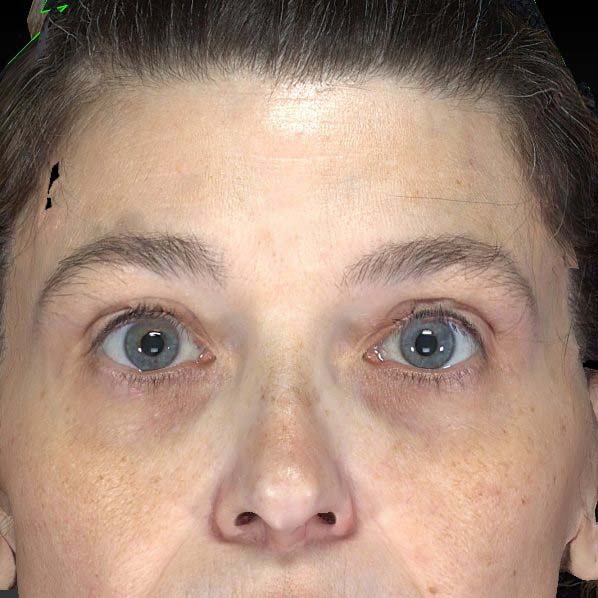 Ultherapy®, case 2, after