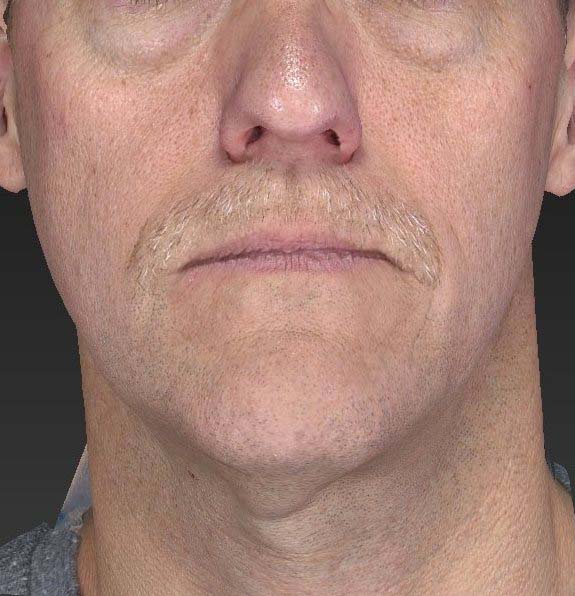 Ultherapy®, case 3, before