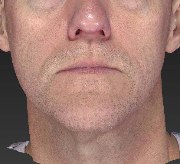 Ultherapy®, case 3, after